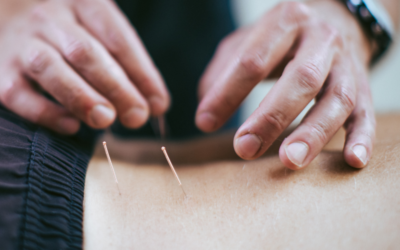 Understanding Needling in Physiotherapy: Acupuncture vs. Dry Needling