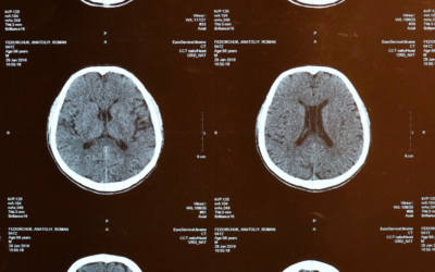The Metabolic Cascade: What Happens to the Brain After a Concussion?